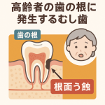 高齢者の歯の根に発生するむし歯